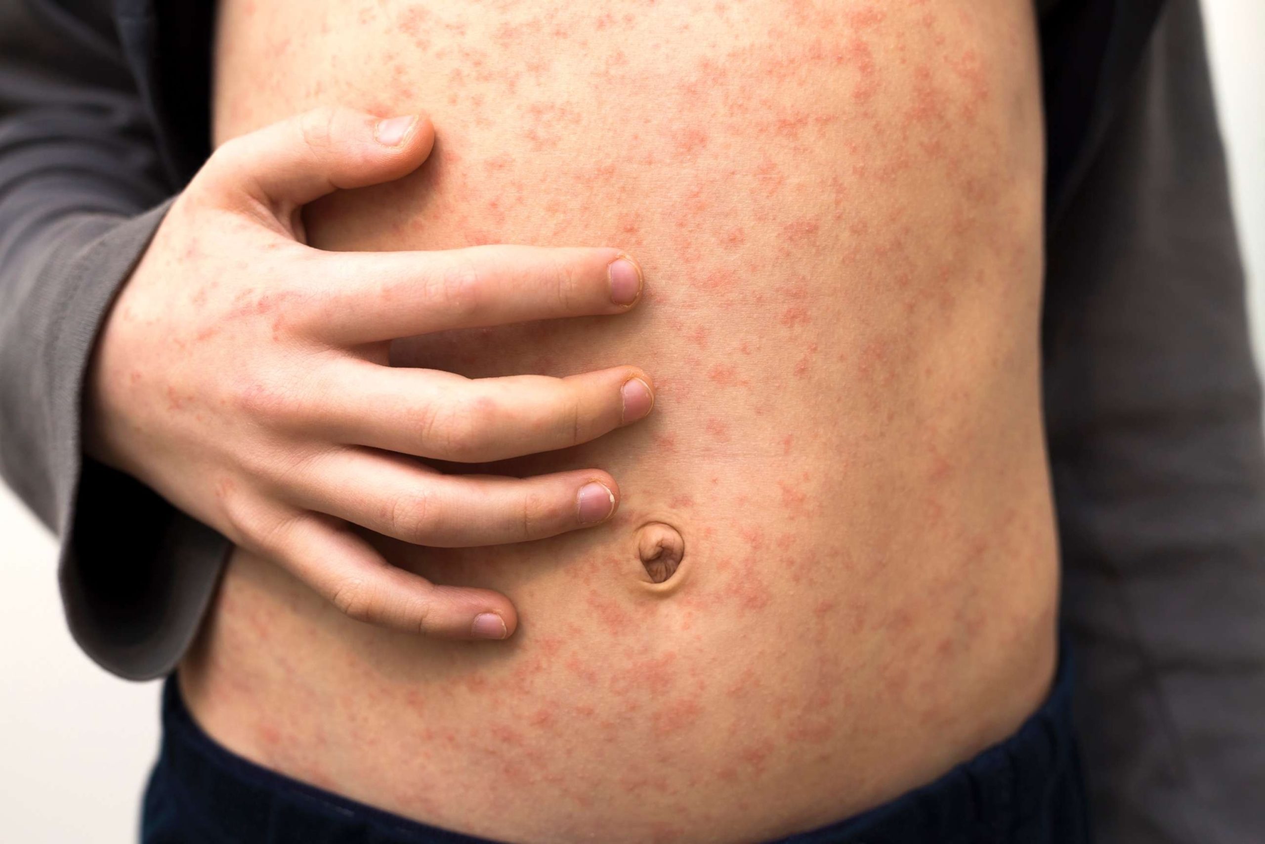 Increasing Number of Measles Cases Prompt CDC's Advisory for Vigilance among Health Care Workers