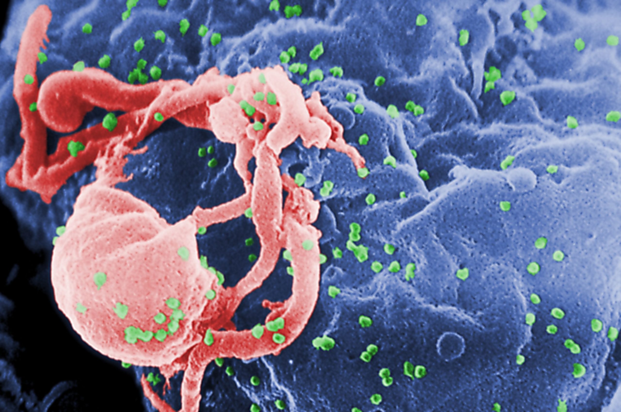 Study finds that 4 children achieve over a year of HIV remission following treatment pause