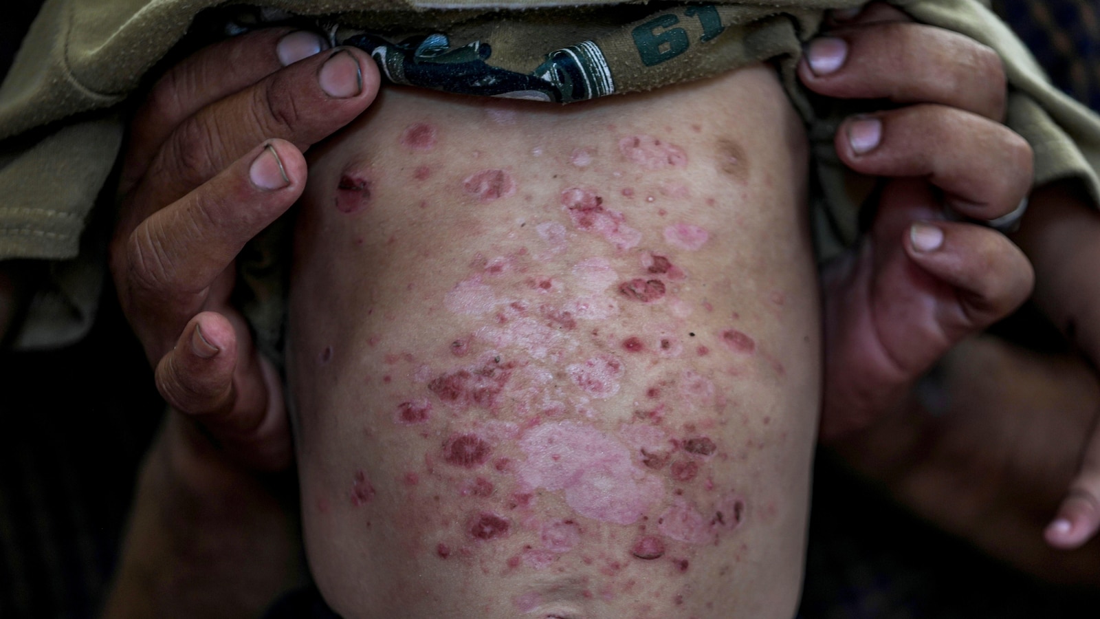 Skin Diseases such as Lice, Scabies, and Rashes are Prevalent among Children in Gaza's Camps